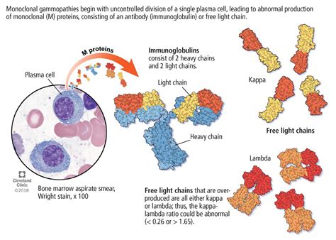 Monoclonal Gammopathy Of Undetermined Significance A Primary Care Guide Cleveland Clinic