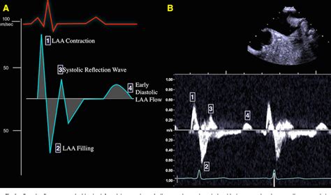 Figure 8 From Left Atrial Appendage Intraoperative Echocardiography