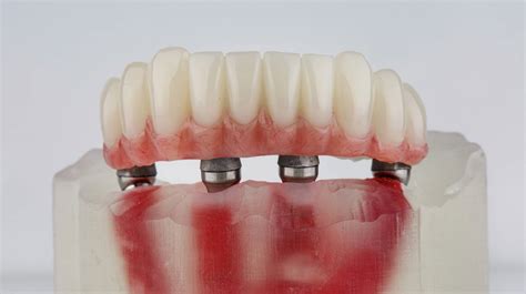 All On 4 Dental Implants In Turkey FindGlob