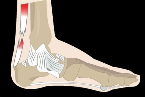 Especialista En Rotura Del Tendon De Aquiles Dr German Pace Osde