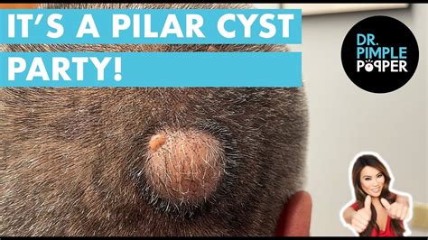 Its A Pilar Cyst Party Youtube