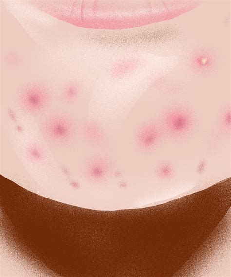 Pinpoint Red Dots On Skin