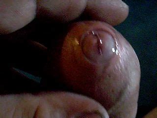 Phimosis Hotntubes Porn