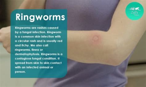 Human Ringworm Symptoms