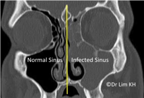 Sinus Surgeon Sinus Specialist Singapore Ent Doctor For Sinusitis