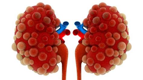 Poliquistosis Renal Causas Síntomas Y Tratamiento