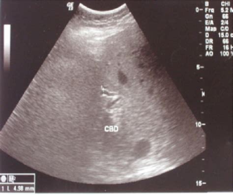 Figure 5 From Agenesis Of The Gallbladder What To Do In Such A Rare Case Presentation Of A