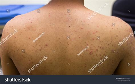 Physical Folliculitis Multiple Pustulated Inflamatory Papule Foto Stock