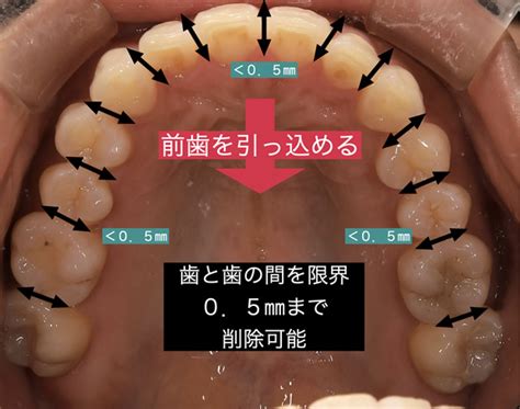 口ゴボは自力で治せるの？口ゴボの予防法や治療方法を徹底解説！大阪でインビザライン30～73万円で矯正治療出っ歯・マウスピース矯正天王寺約10分