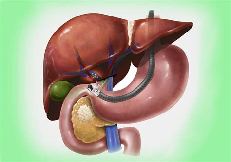 ERCP Endoscopic Retrograde Cholangiopancreatography