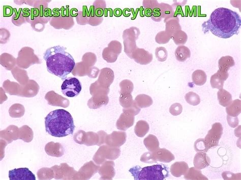 Blood Morphology Ask Hematologist Understand Hematology