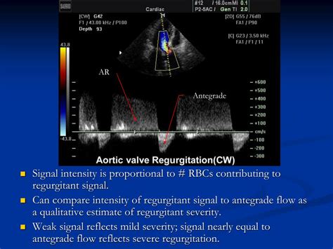 Ppt Aortic Regurgitation Powerpoint Presentation Free Download Id4667990