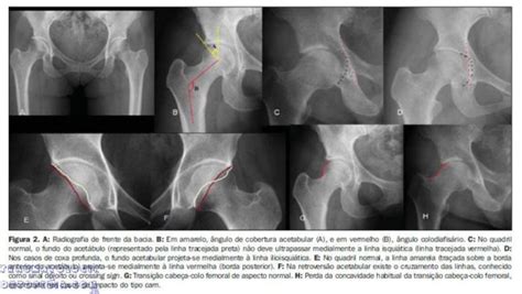 Radiologia Do Quadril E Pelve Traumatologia E Ortopedia