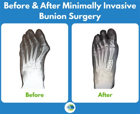 Minimally Invasive Bunion Surgery What You Need To Know The Frankel