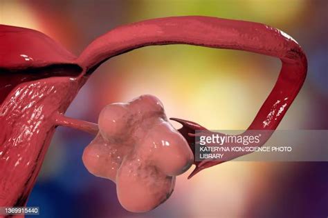 Polycystic Ovary Syndrome Pcos High Res Illustrations Getty Images