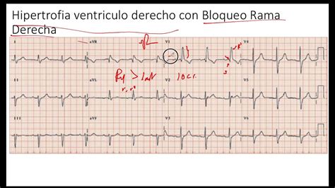 Hipertrofia Ventriculo Derecho Con Bloqueo De Rama Derecha EKG YouTube