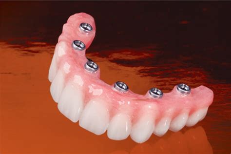 Screw-Retained Crowns | Method Dental