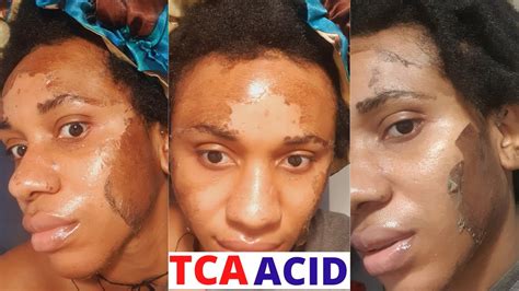 Diy Tca Peel At Home Day By Day Progress On Black Skin Part