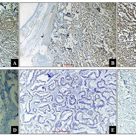 Immunohistochemistry A Chromogranin Strong And Diffuse Cytoplasmic