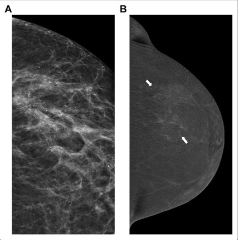 A And B An Example Of High Grade Ductal Carcinoma In Situ 62 Year Old