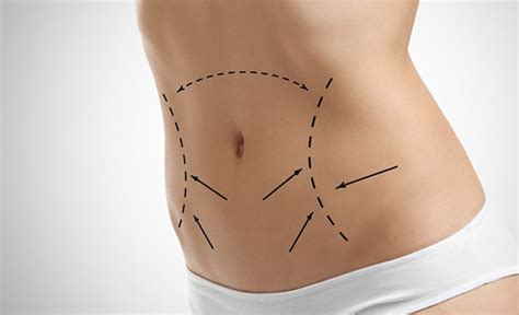 Tummy Tuck Surgery In Turkey Abdominoplasty Eylem Clinic