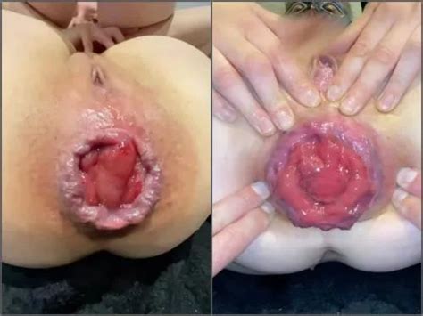 Girl Gets Fisted Anal Insertion My Kinky Wife M Pro Giant Anal Prolapse Loose Again And Again