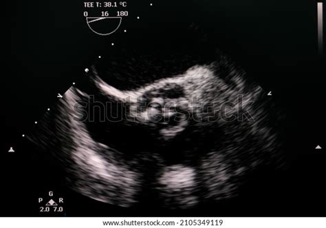 Transesophageal Echocardiogram Showing Calcified Severe Aortic Stock