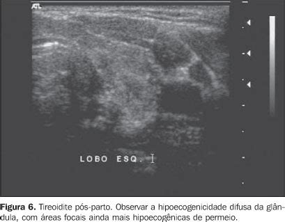 Radiologia Brasileira Achados Ultra Sonogr Ficos Na Tireoidite