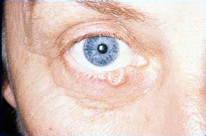 Eyelid Tumor Treatment Lancaster, PA - Tumor Care Lititz