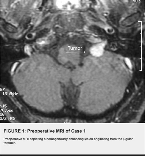 Figure 1 From Evolution Of The Intracranial Approaches To Jugular