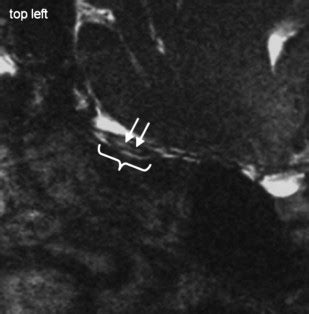 Pathology of the Olfactory Nerve | Radiology Key 
