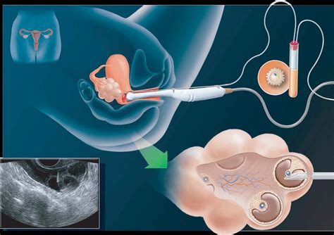 Wie Funktioniert Eine K Nstliche Befruchtung Pregnancy Depression