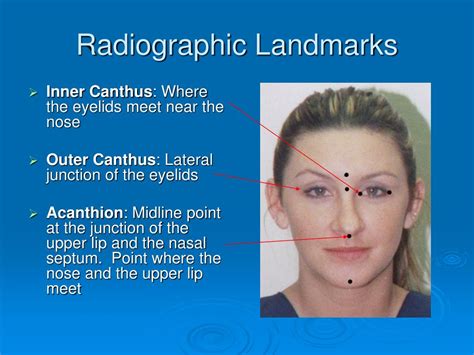 Radiographic Landmarks