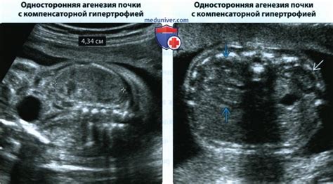 УЛЬТРАЗВУКОВАЯ ДИАГНОСТИКА ЗАБОЛЕВАНИЙ ПОЧЕК В ПЕРИНАТАЛЬНОМ ПЕРИОДЕ ...