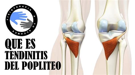 Tendinitis Poplitea Que Es Y Porque Se Produce El Dolor Detras De La