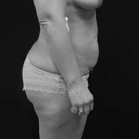 Abdominoplastie Avec Transposition De Lombilic Dr Amandine Bonte