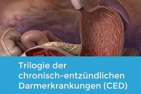 Cme Trilogie Der Chronisch Entz Ndlichen Darmerkrankungen Ced