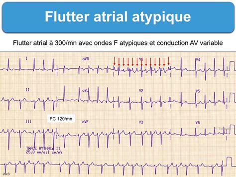 Flutter Atrial 1 Généralités E Cardiogram