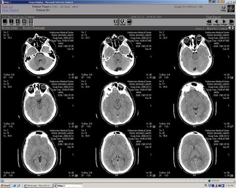 Signs Of A Mini Stroke Transient Ischemic Attack Symptoms Tias