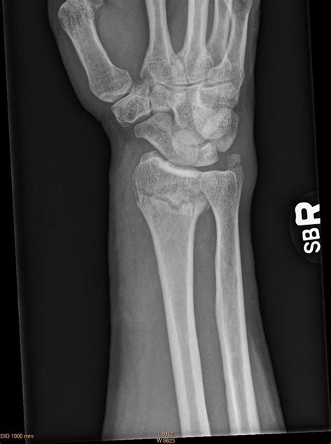 Just Sharing: Broken Wrist - Surgery A Couple of Days Ago : r/brokenbones