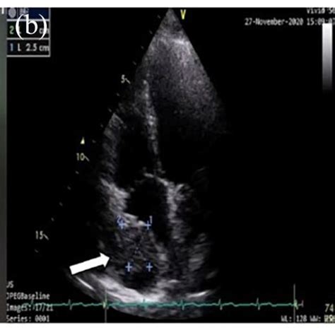 Follow Up Echocardiography Echocardiography 1 Week After Surgery