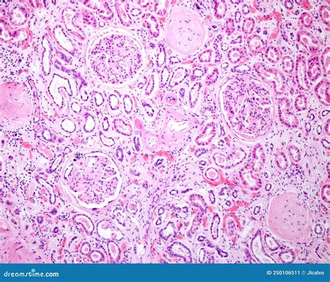 Human Kidney Diabetic Nephropathy Stock Image Image Of Diabetic