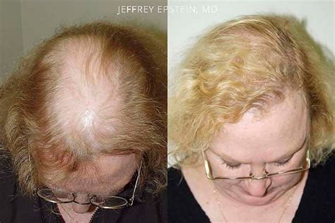 Hair Transplant For Women Miami Hair Implants For Women