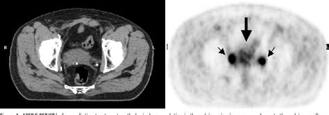 Figure 1 From Consolidation Radiotherapy For A Rare Case Of Extranodal Mucosa Associated