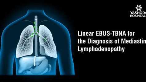 Mediastinal Lymphadenopathy