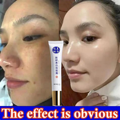 Whitening Cream Fast Effective Freckle Removal Original Niacinamide