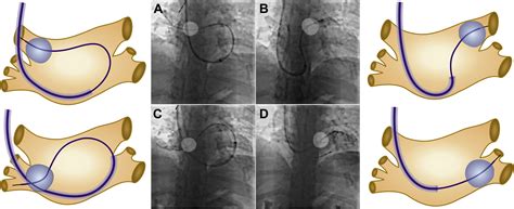 Successful Transseptal Puncture And Cryoballoon Ablation Of Symptomatic Paroxysmal Atrial