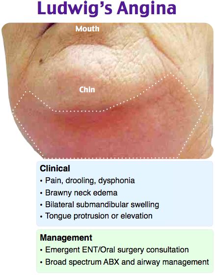 Ludwigs Angina Dental Hygiene School Emergency Nursing Medical