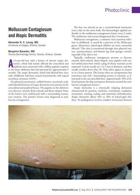 Molluscum Contagiosum And Atopic Dermatitis Docslib