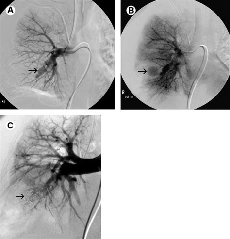 Bronchial Artery Embolization Techniques In Vascular Interventional